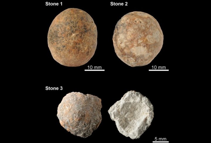 Найдавніші камені в простаті виявили у чоловіка кам'яного віку (фото)