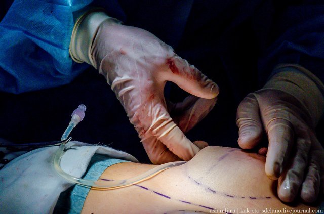 Як робляться операції по збільшенню грудей (фото)