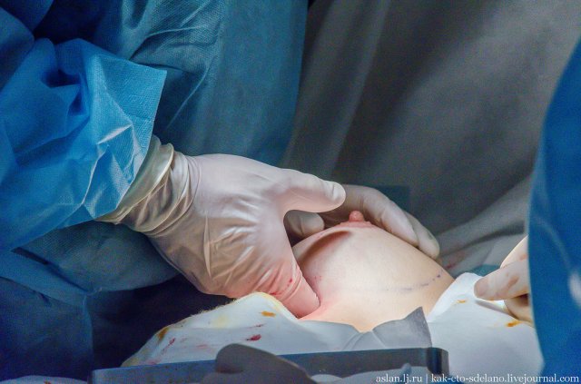 Як робляться операції по збільшенню грудей (фото)