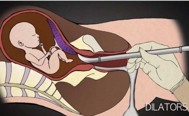 Як насправді виглядає аборт? (відео)