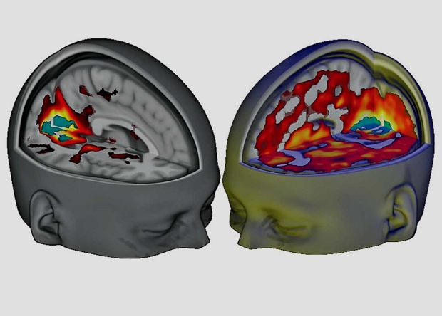 Мозок людини під ЛСД вперше розглянули в МРТ