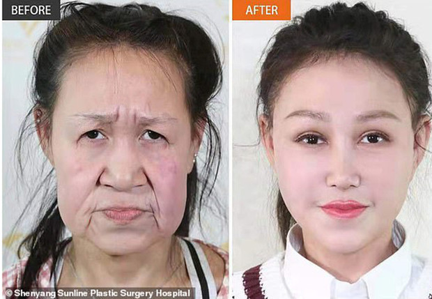 Китайська дівчинка через рідкісну хворобу в 15 років виглядала як бабця, але пластична операція все виправила