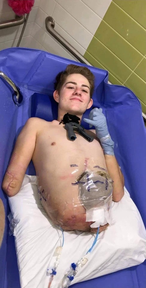 Переможець смерті: як 19-річний американець живе після ампутації нижньої частини тіла (фото)